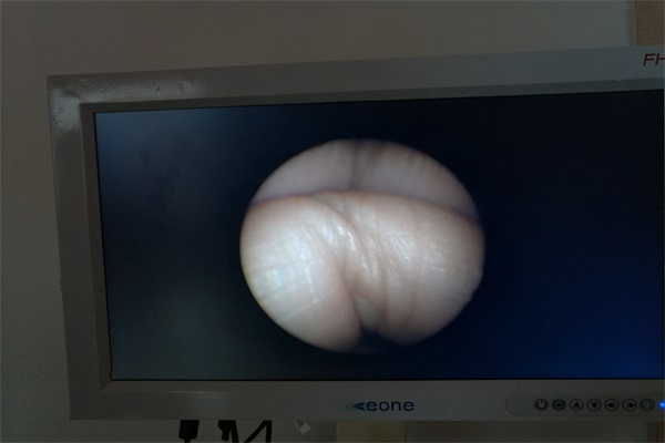 腹腔镜监视器 腹腔镜监视器